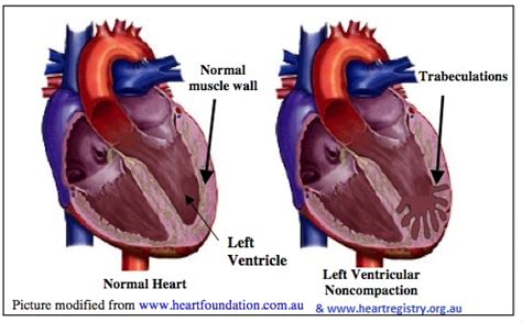 non compaction cardiomyopathy life expectancy